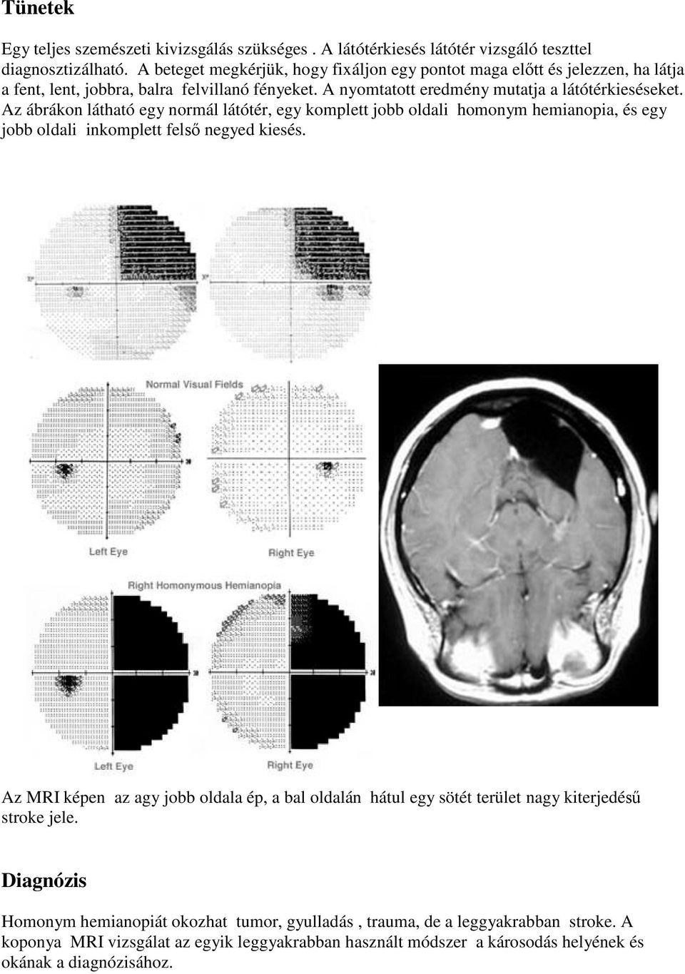 Az ábrákon látható egy normál látótér, egy komplett jobb oldali homonym hemianopia, és egy jobb oldali inkomplett felső negyed kiesés.