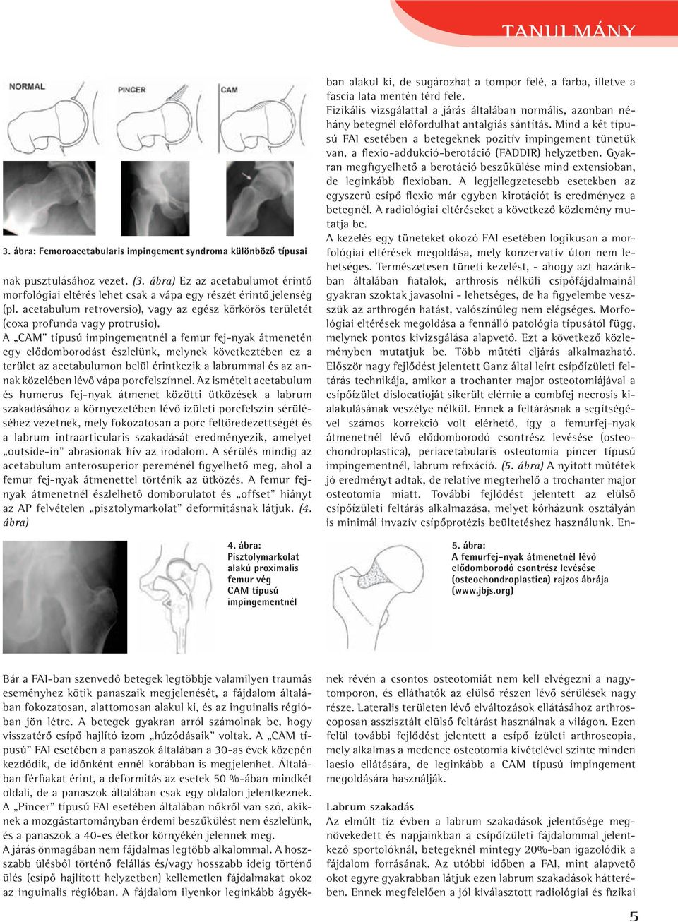 A CAM típusú impingementnél a femur fej-nyak átmenetén egy elôdomborodást észlelünk, melynek következtében ez a terü let az acetabulumon belül érintkezik a labrummal és az annak közelében lévô vápa