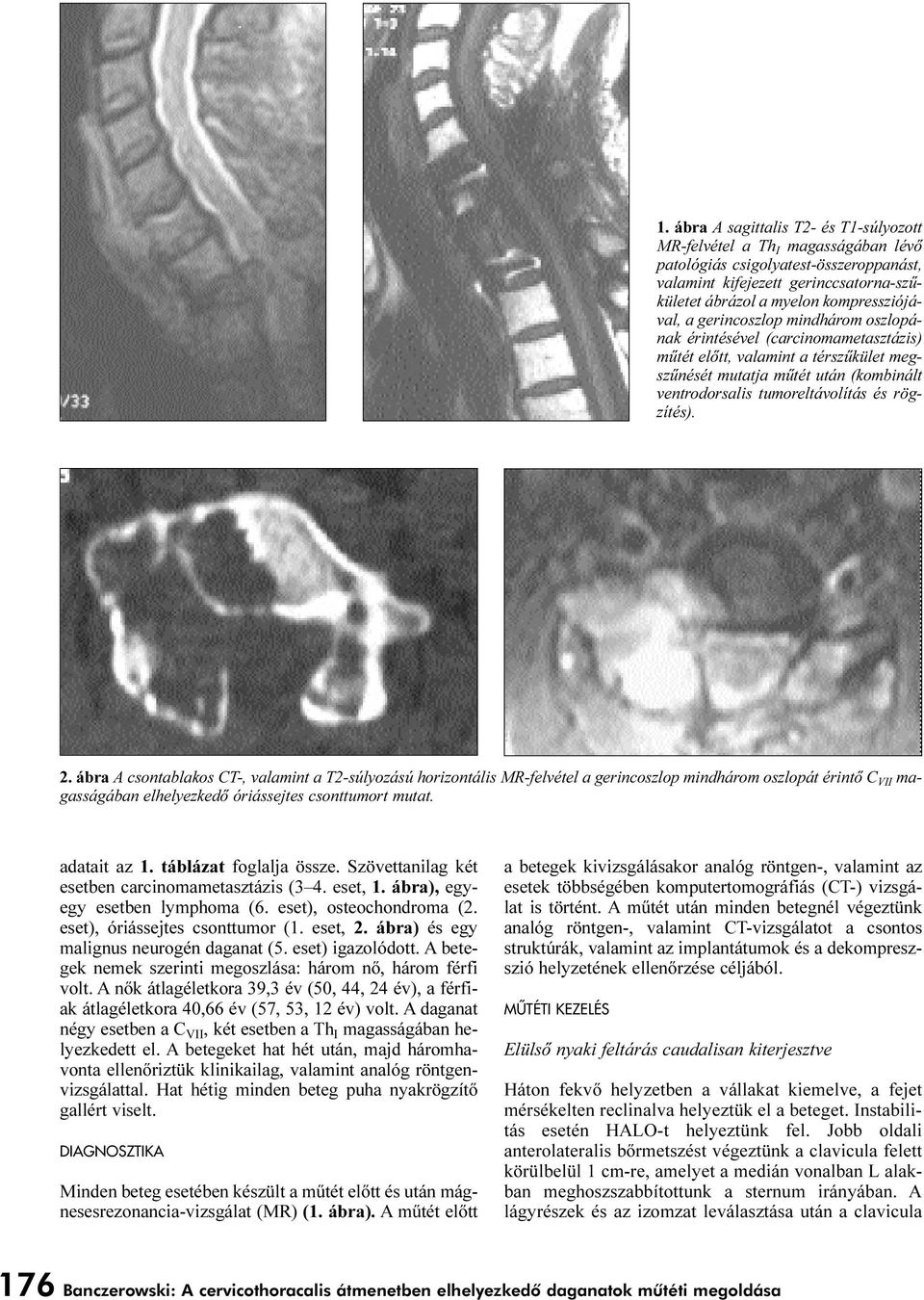 ábra A csontablakos CT-, valamint a T2-súlyozású horizontális MR-felvétel a gerincoszlop mindhárom oszlopát érintõ C VII magasságában elhelyezkedõ óriássejtes csonttumort mutat. adatait az 1.