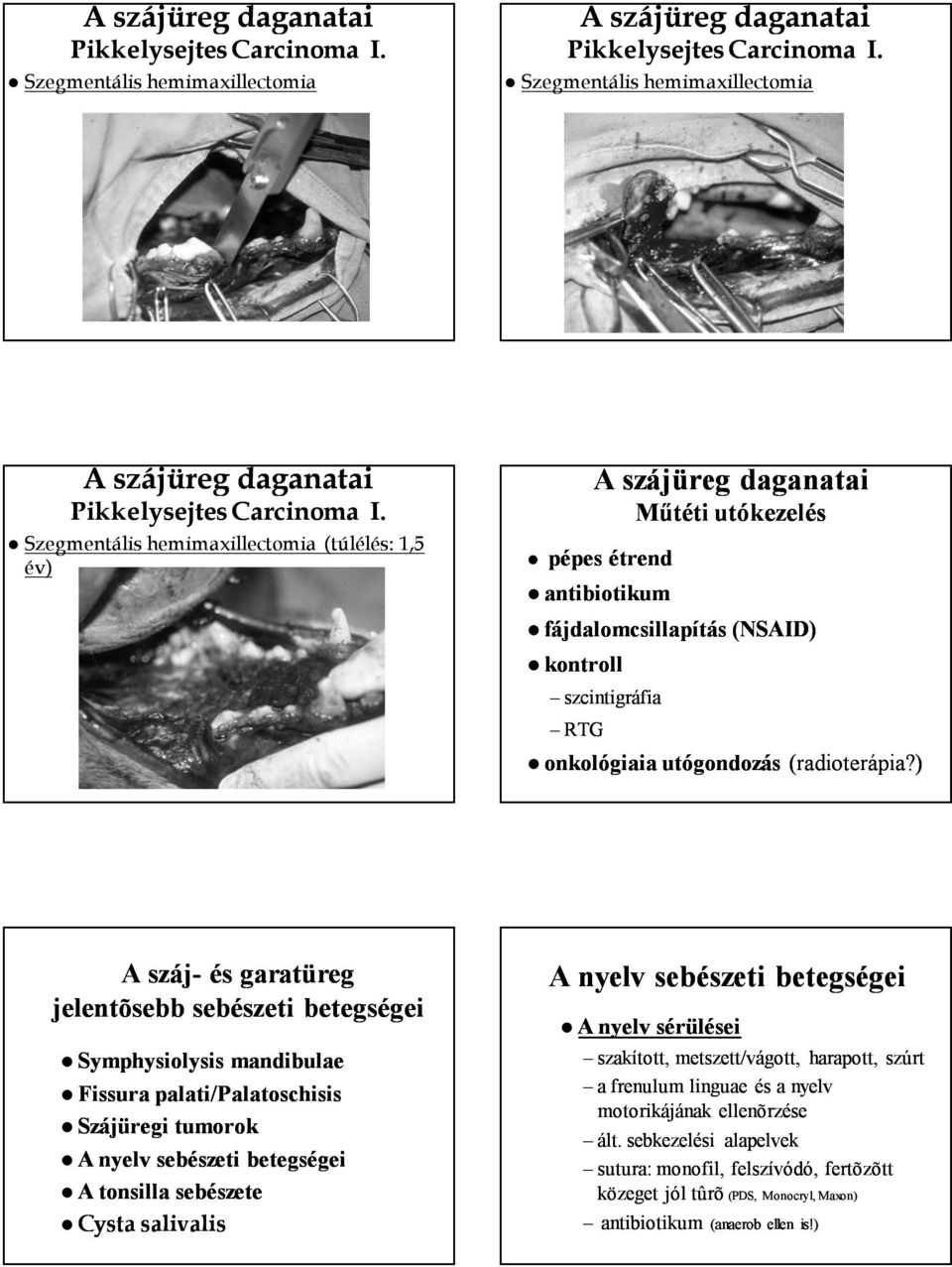 Szegmentális hemimaxillectomia (túlélés: 1,5 év) Műtéti utókezelés pépes étrend antibiotikum fájdalomcsillapítás (NSAID) kontroll szcintigráfia RTG onkológiaia utógondozás (radioterápia?