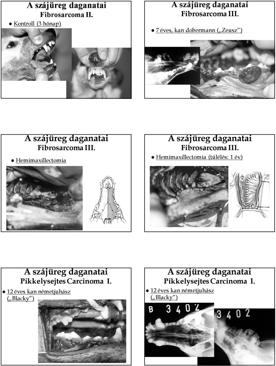 Hemimaxillectomia Fibrosarcoma III.