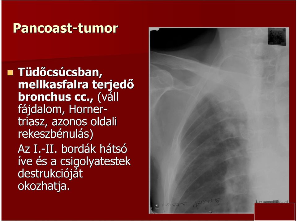 , (váll fájdalom, Horner- triasz,, azonos oldali