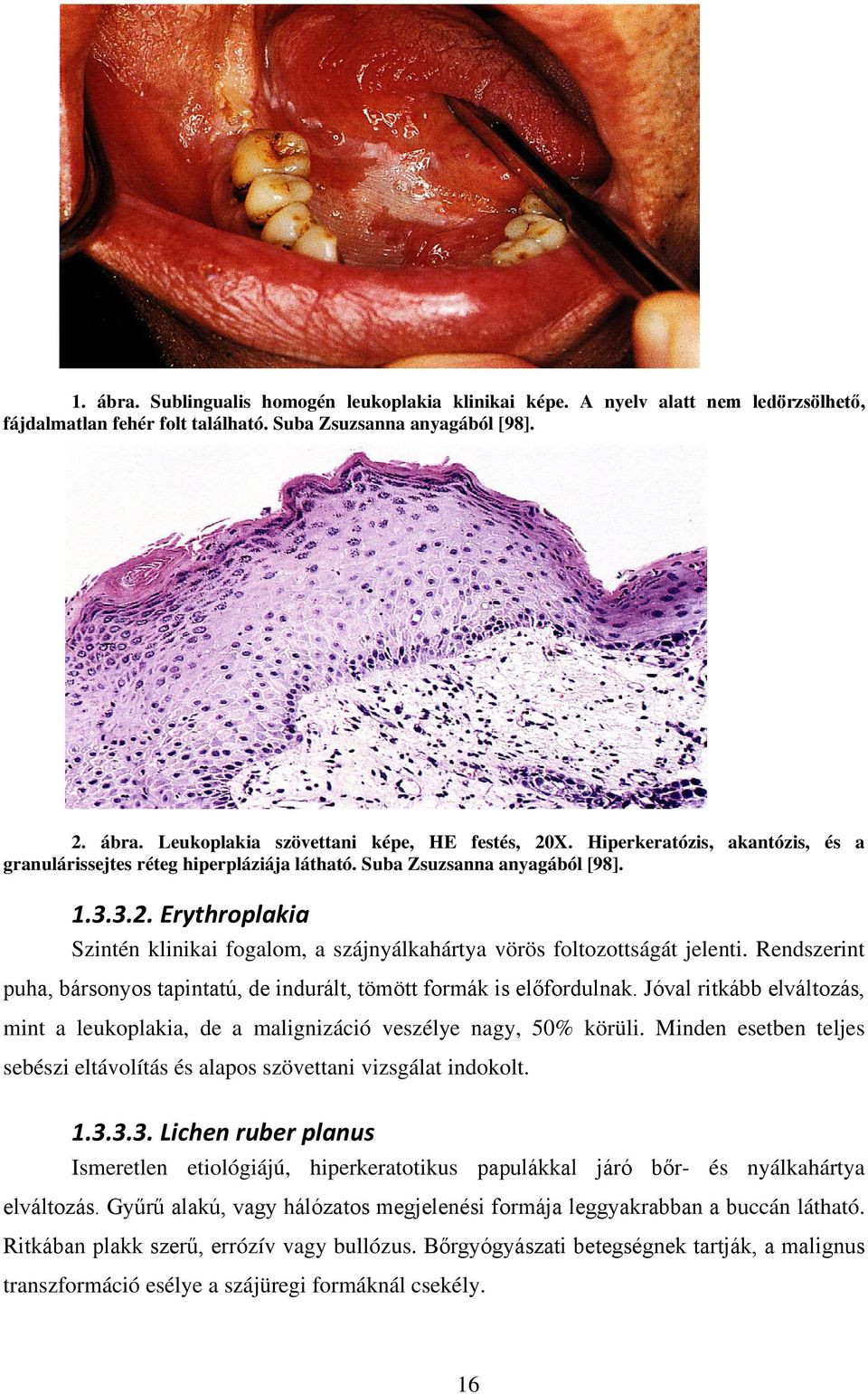 Erythroplakia Szintén klinikai fogalom, a szájnyálkahártya vörös foltozottságát jelenti. Rendszerint puha, bársonyos tapintatú, de indurált, tömött formák is előfordulnak.