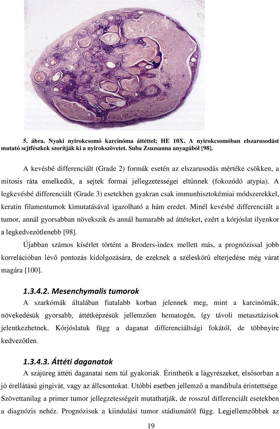 A legkevésbé differenciált (Grade 3) esetekben gyakran csak immunhisztokémiai módszerekkel, keratin filamentumok kimutatásával igazolható a hám eredet.