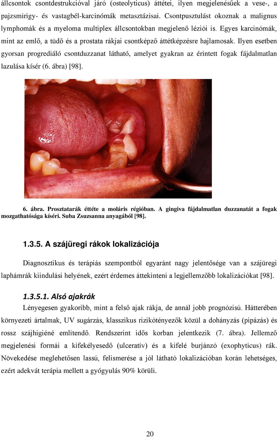 Ilyen esetben gyorsan progrediáló csontduzzanat látható, amelyet gyakran az érintett fogak fájdalmatlan lazulása kísér (6. ábra) [98]. 6. ábra. Prosztatarák éttéte a moláris régióban.