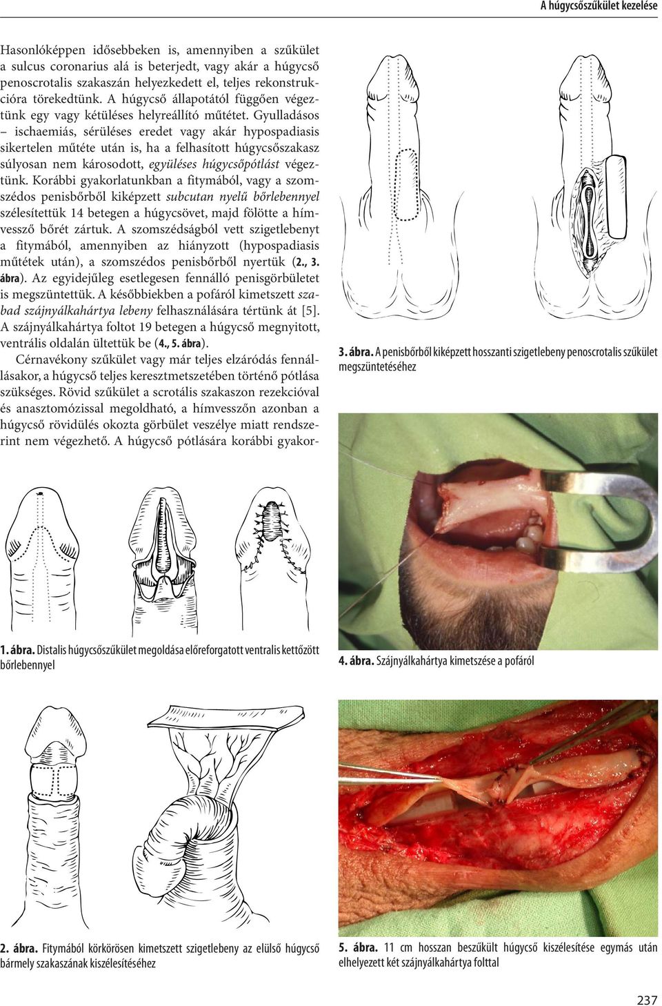 Gyulladásos ischaemiás, sérüléses eredet vagy akár hypospadiasis sikertelen műtéte után is, ha a felhasított húgycsőszakasz súlyosan nem károsodott, együléses húgycsőpótlást végeztünk.