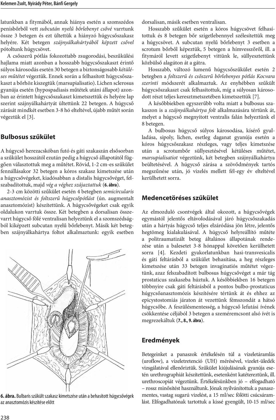 A csőszerű pótlás fokozottabb zsugorodási, beszűkülési hajlama miatt azonban a hosszabb húgycsőszakaszt érintő súlyos károsodás esetén 30 betegen a biztonságosabb kétüléses műtétet végeztük.