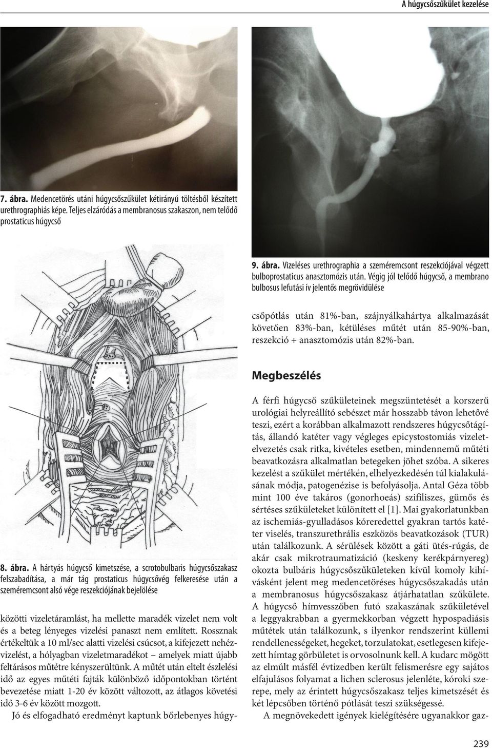 Rossznak értékeltük a 10 ml/sec alatti vizelési csúcsot, a kifejezett nehézvizelést, a hólyagban vizeletmaradékot amelyek miatt újabb feltárásos műtétre kényszerültünk.