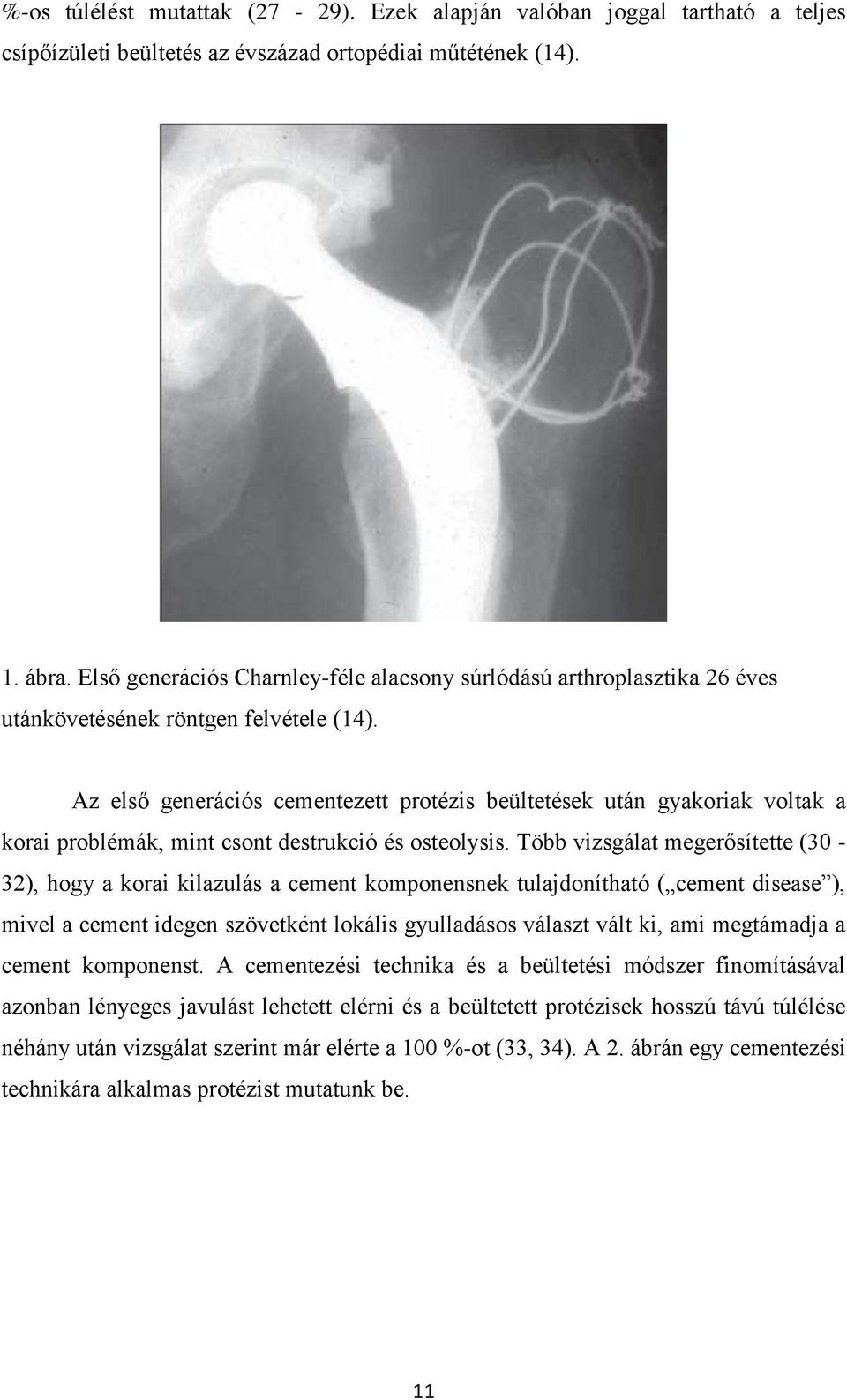 Az első generációs cementezett protézis beültetések után gyakoriak voltak a korai problémák, mint csont destrukció és osteolysis.