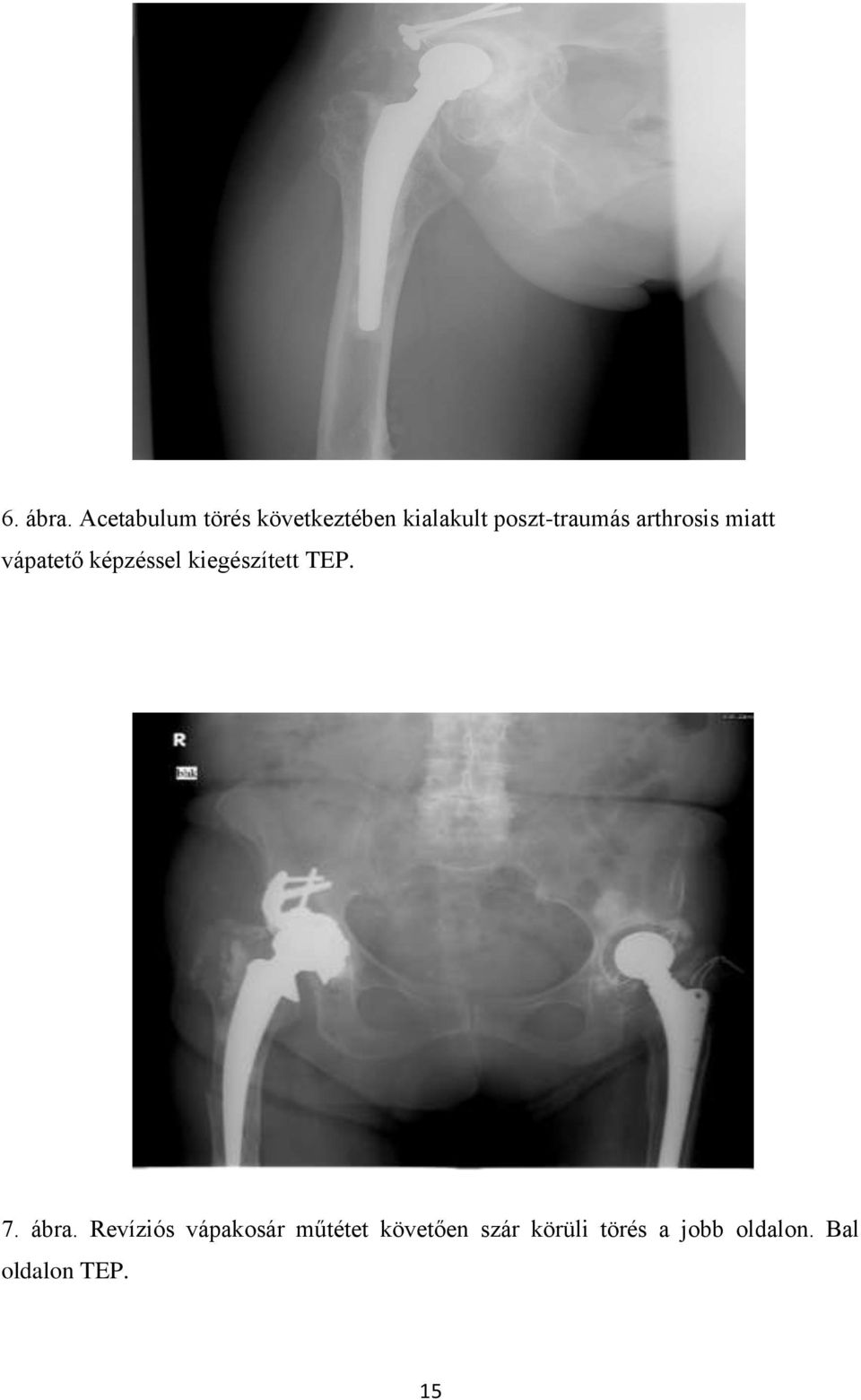 poszt-traumás arthrosis miatt vápatető képzéssel