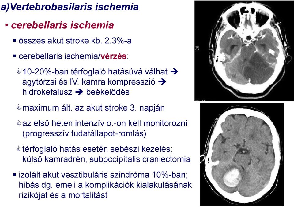 kamra kompresszió hidrokefalusz beékelődés maximum ált. az akut stroke 3. napján az első heten intenzív o.