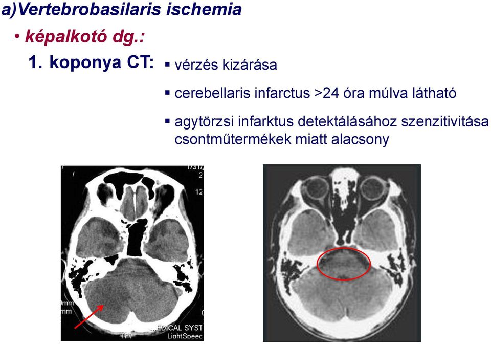 infarctus >24 óra múlva látható agytörzsi