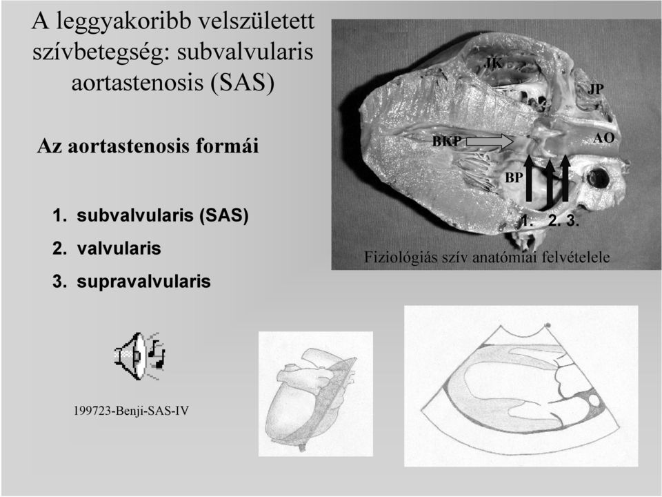 1. subvalvularis (SAS) 2. valvularis 3. supravalvularis 1.