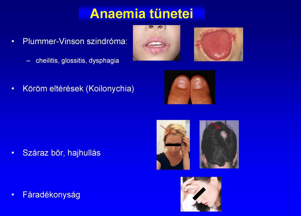 dysphagia Köröm eltérések