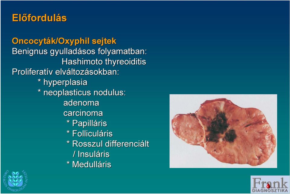 elváltoz ltozásokban: * hyperplasia * neoplasticus nodulus: adenoma