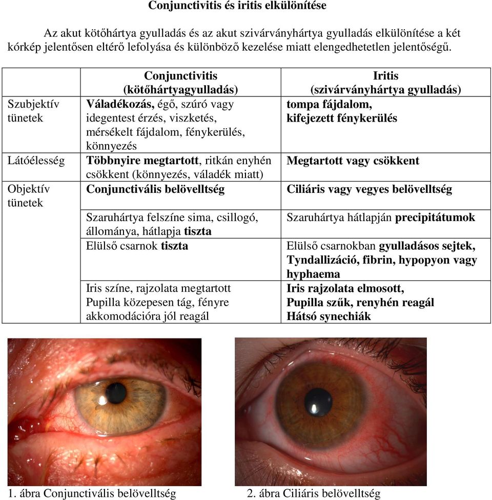 Szubjektív tünetek Látóélesség Objektív tünetek Conjunctivitis (kötőhártyagyulladás) Váladékozás, égő, szúró vagy idegentest érzés, viszketés, mérsékelt fájdalom, fénykerülés, könnyezés Többnyire