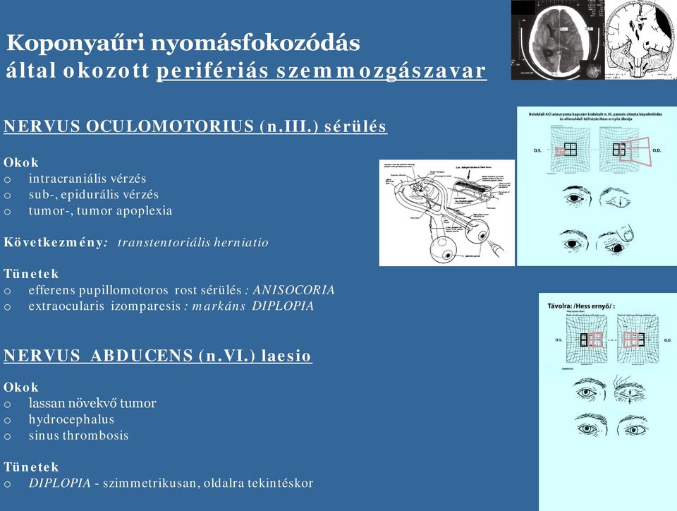 transtentriális herniati Tünetek efferens pupillmtrs rst sérülés : ANISOCORIA extracularis izmparesis :