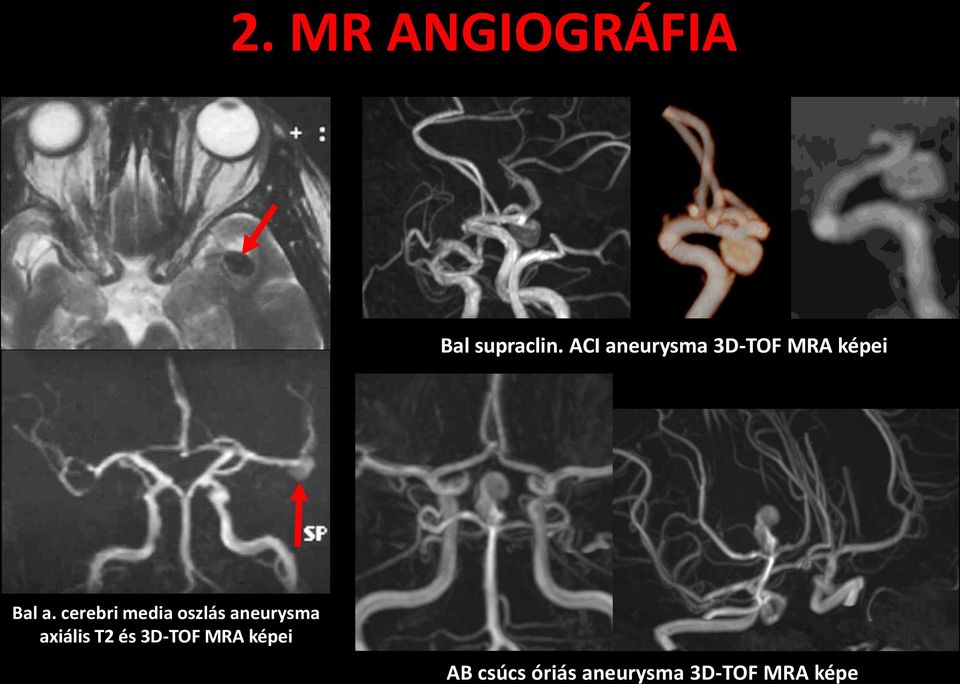 cerebri media oszlás aneurysma axiális T2