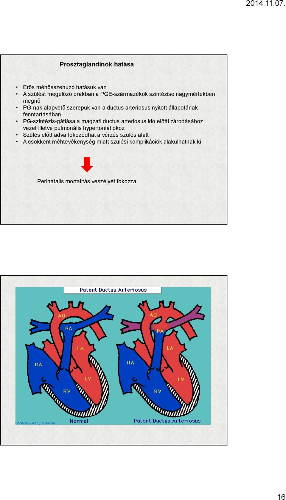 PG-szintézis-gátlása a magzati ductus arteriosus idő előtti zárodásához vezet illetve pulmonális hypertoniát okoz Szülés