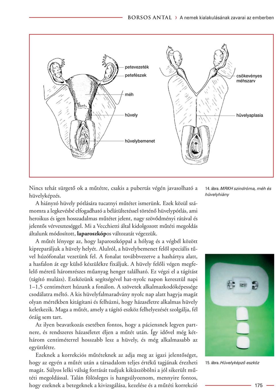 Ezek közül számomra a legkevésbé elfogadható a bélátültetéssel történô hüvelypótlás, ami heroikus és igen hosszadalmas mûtétet jelent, nagy szövôdményi rátával és jelentôs vérveszteséggel.