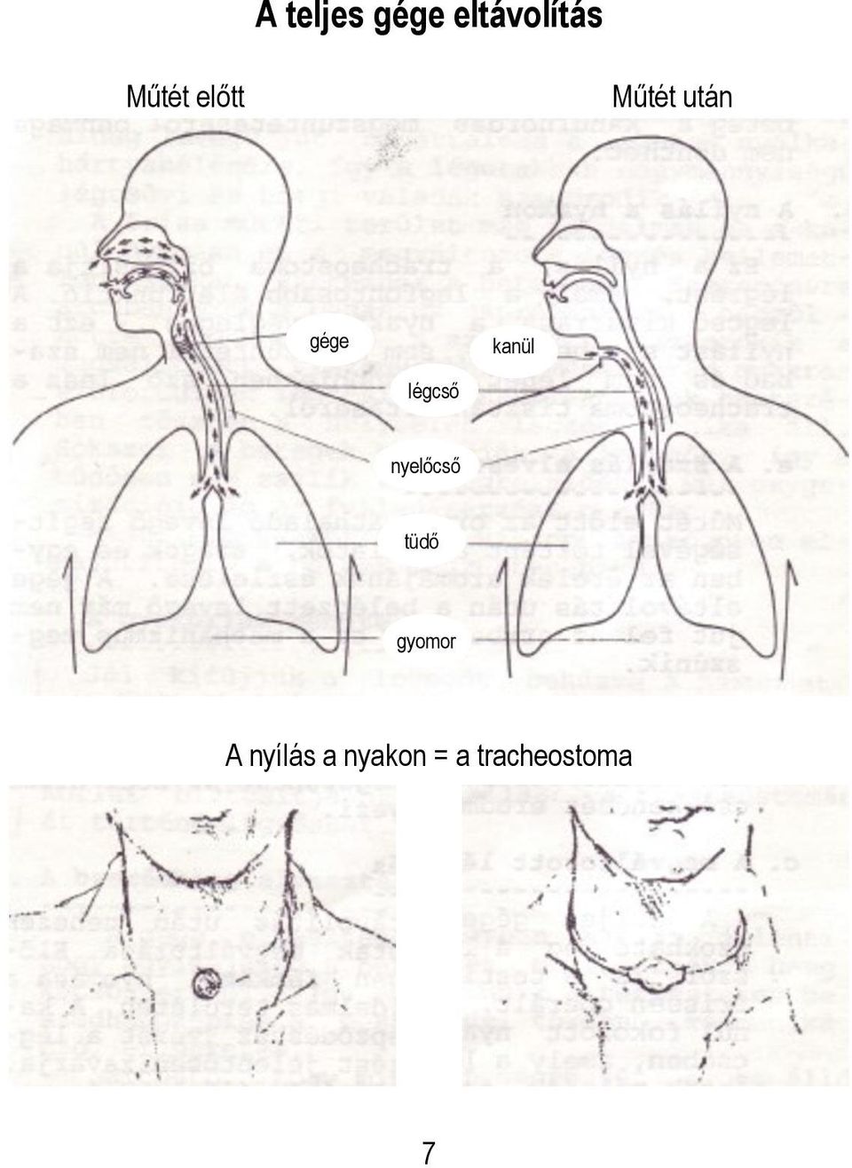 kanül légcső nyelőcső tüdő