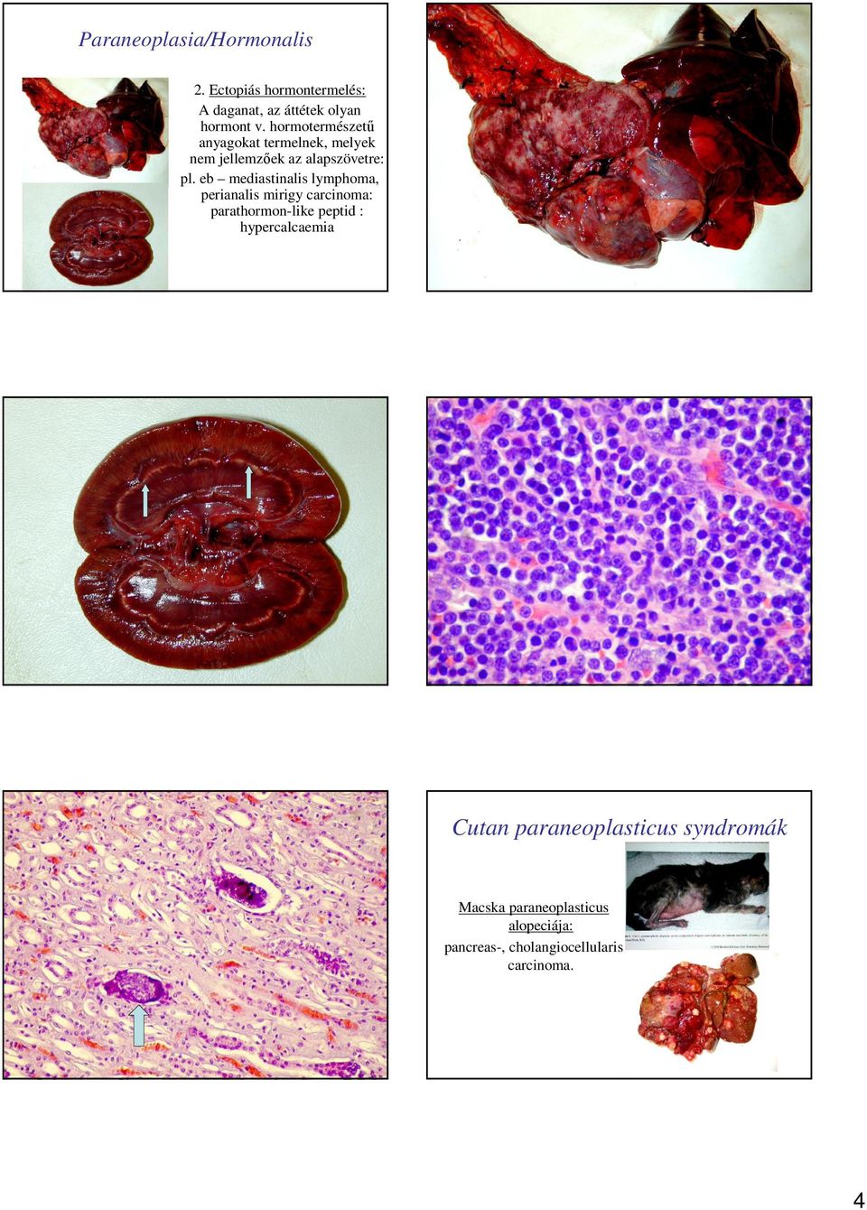 eb mediastinalis lymphoma, perianalis mirigy carcinoma: parathormon-like peptid :