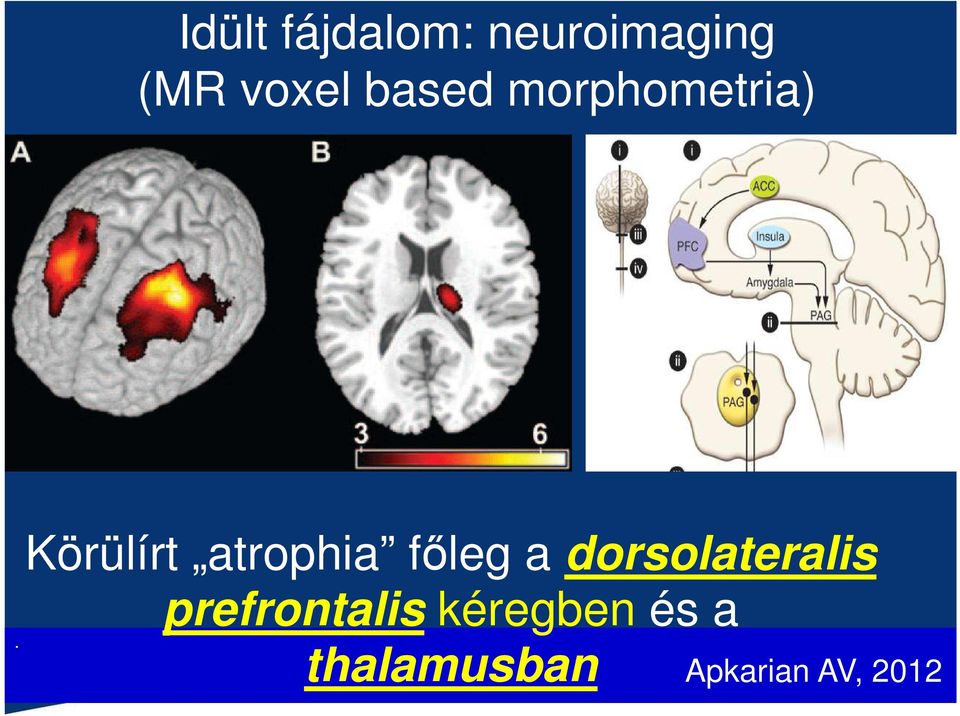 Körülírt atrophia főleg a dorsolateralis