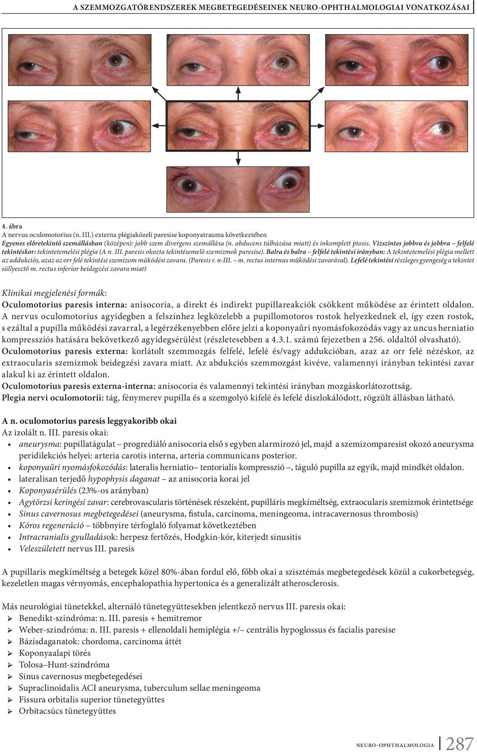 Balra és balra felfelé tekintési irányban: A tekintetemelési plégia mellett az addukciós, azaz az orr felé tekintési szemizom működési zavara. (Paresis r. n-iii. m. rectus internus működési zavarával).