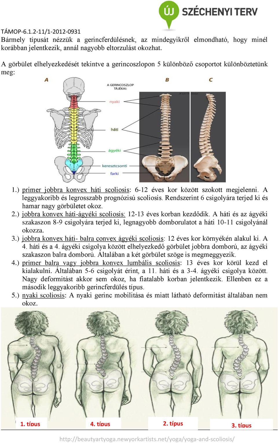 A leggyakoribb és legrosszabb prognózisú scoliosis. Rendszerint 6 csigolyára terjed ki és hamar nagy görbületet okoz. 2.) jobbra konvex háti-ágyéki scoliosis: 12-13 éves korban kezdődik.