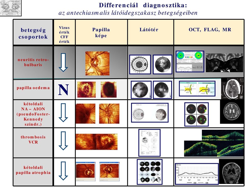 Látótér OCT, FLAG, MR neuritis retrbulbaris & papilla edema N