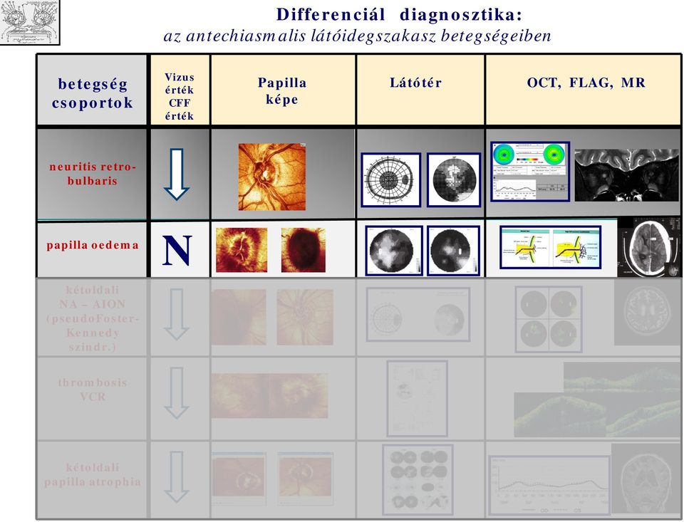 Látótér OCT, FLAG, MR neuritis retrbulbaris & papilla edema N