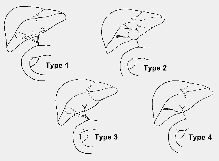 Epeút atresia Az extrahepatikus forma gyakoribb