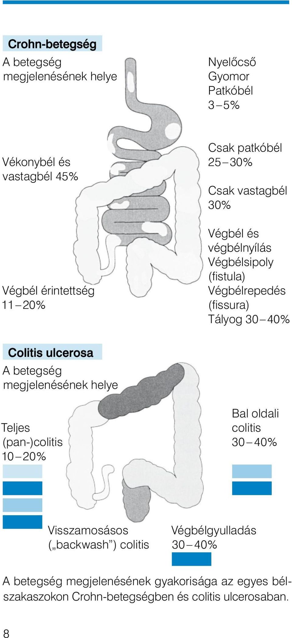 Colitis ulcerosa A betegség megjelenésének helye Bal oldali Teljes colitis (pan-)colitis 30 40% 10 20% Visszamosásos ( backwash )