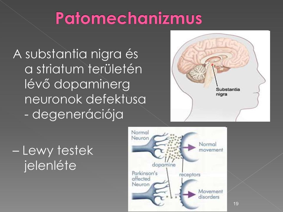 dopaminerg neuronok defektusa