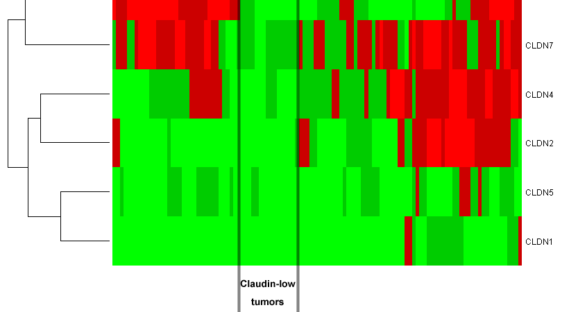 Claudin-low 97 invazív emlőcarcinoma 38 tripla negatív emlőrák Tripla neg.