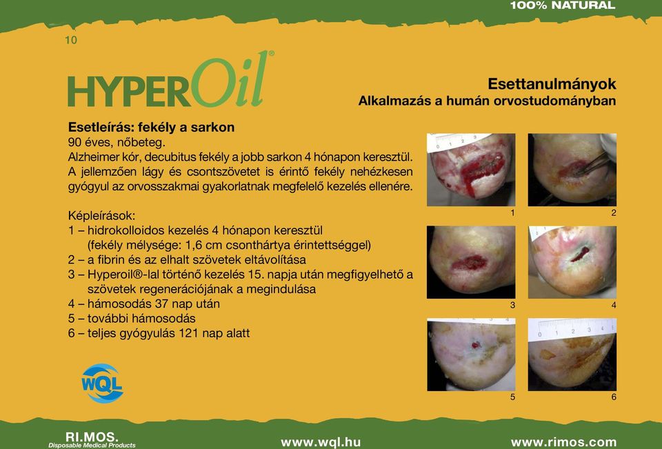 Képleírások: 1 hidrokolloidos kezelés 4 hónapon keresztül (fekély mélysége: 1,6 cm csonthártya érintettséggel) 2 a fibrin és az elhalt szövetek