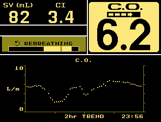 NICO (Non-invasive cardiac output monitoring) A perctérfogat