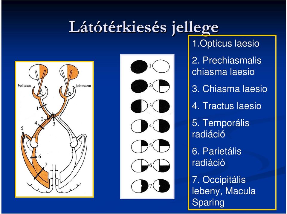 Chiasma laesio 4. Tractus laesio 5.