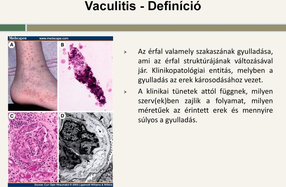 Klinikopatológiai entitás, melyben a gyulladás az erek károsodásához vezet.