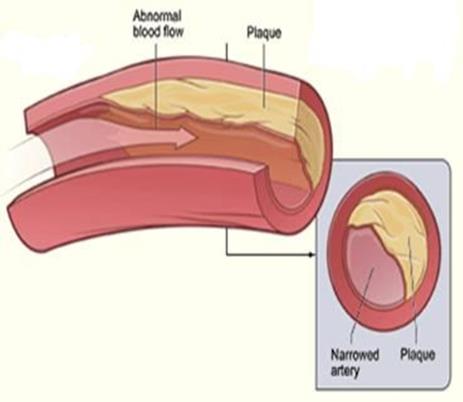 endothelium sejt artéria fala óriás LDL részecske kicsi LDL részecske endothélium rés abnormális áramlás plakk plakk szűkült artéria 27.