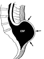 Meningokele: a distendált spinalis meninxek