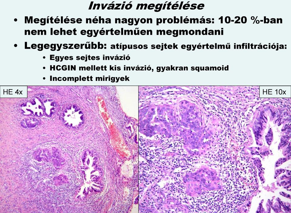 egyértelmű infiltrációja: Egyes sejtes invázió HCGIN mellett kis