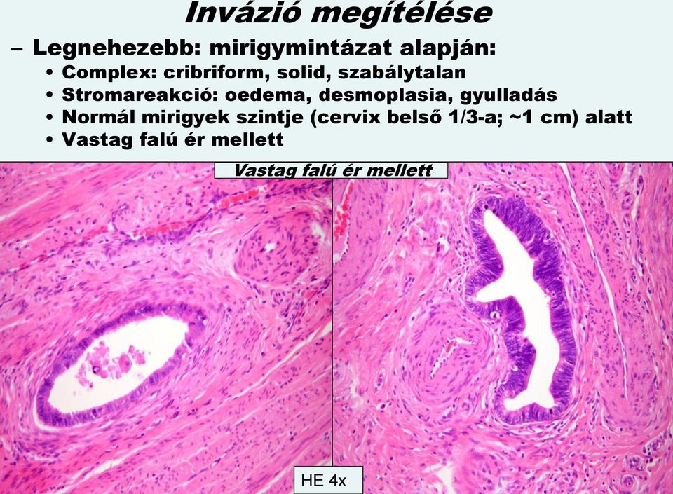 mirigyek szintje (cervix belső 1/3-a; ~1 cm) alatt Vastag falú ér mellett