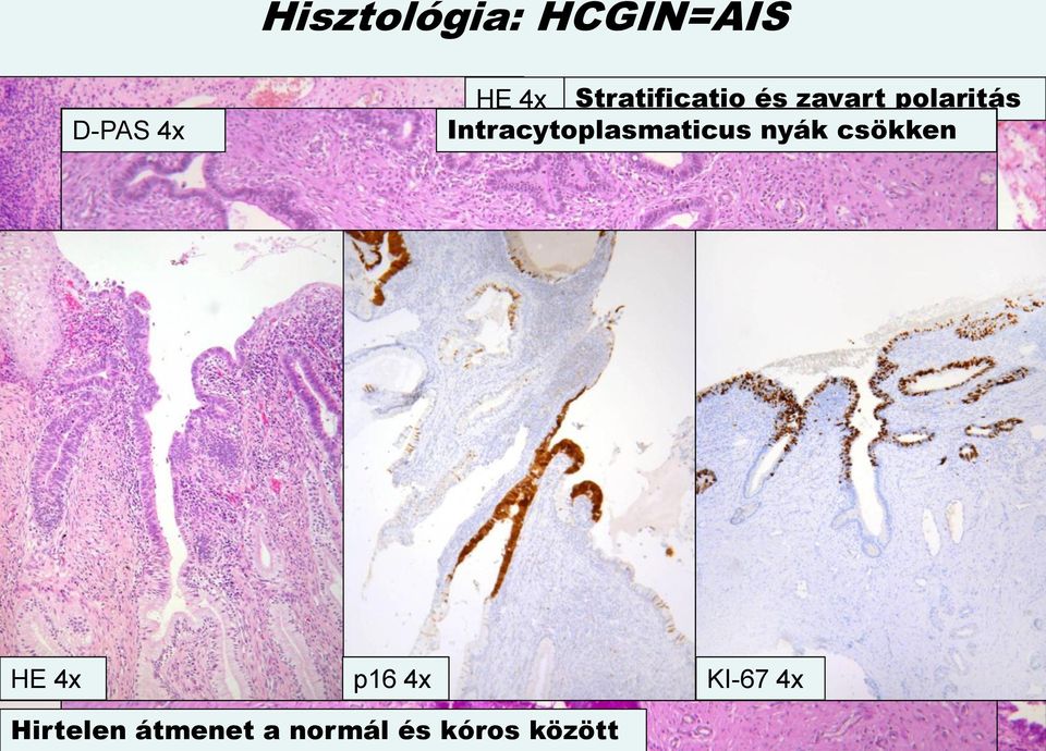 Intracytoplasmaticus nyák csökken HE 4x