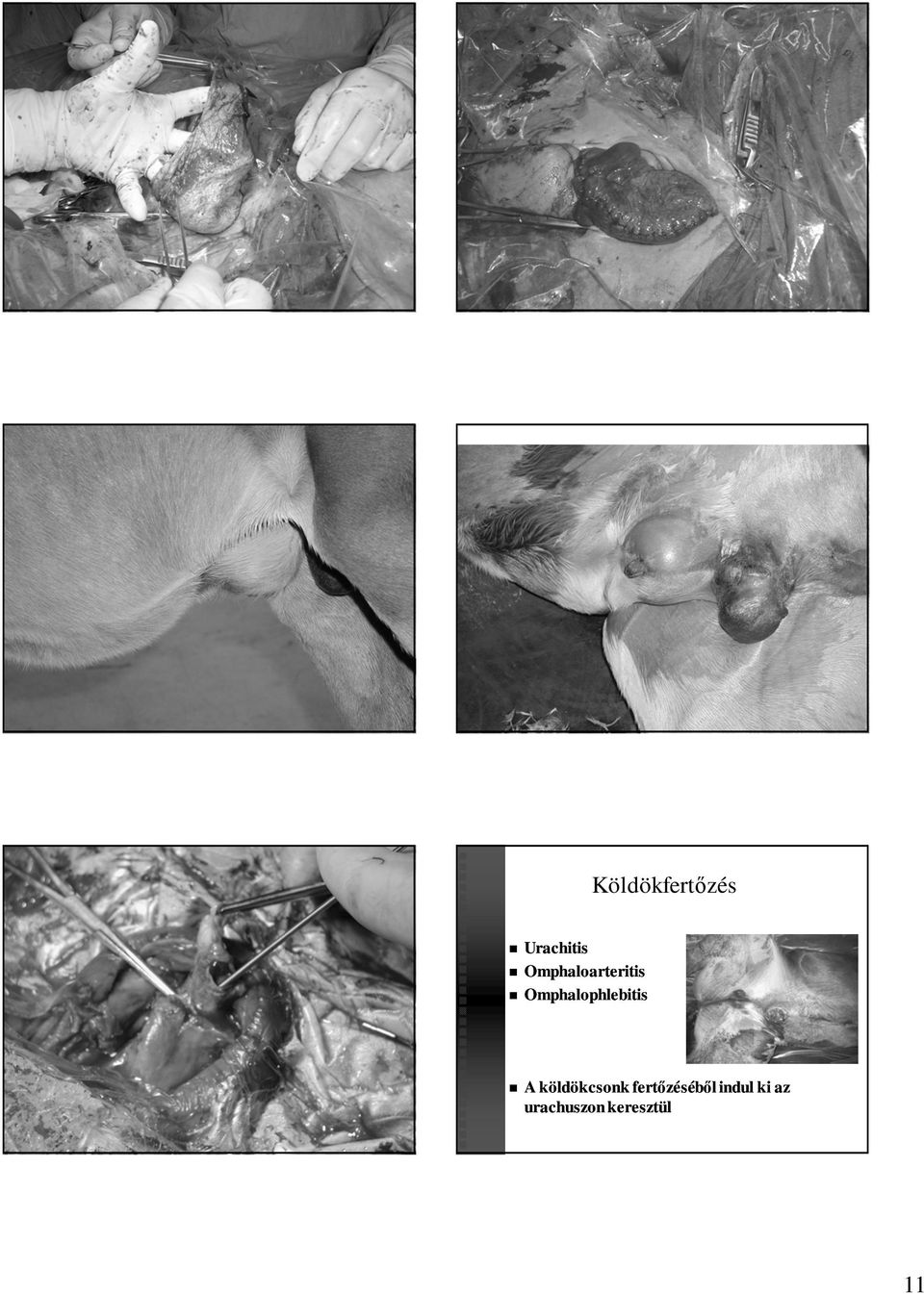 Omphalophlebitis A köldökcsonk