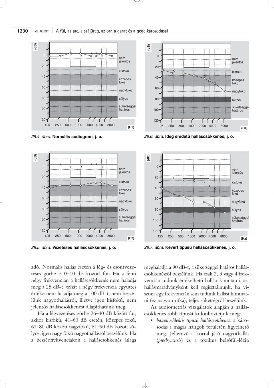 Ha a fenti négy frekvencián a halláscsökkenés nem haladja meg a 25 db-t, tehát a négy frekvencia együttes értéke nem haladja meg a 100 db-t, nem beszélünk nagyothallásról, illetve igen kisfokú, nem