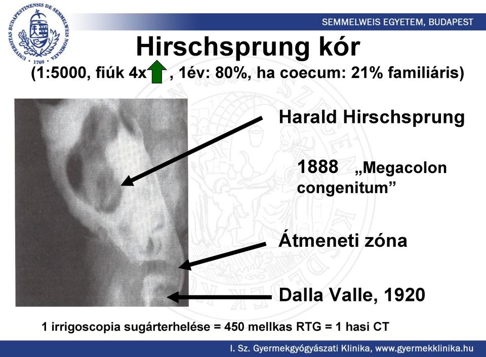 Megacolon congenitum Átmeneti zóna Dalla Valle, 1920