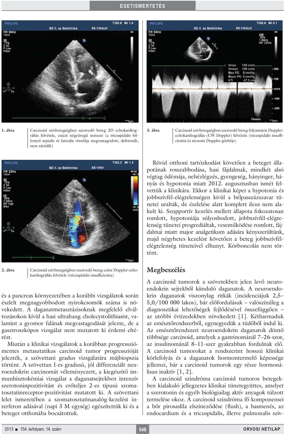 ábra Carcinoid szívbetegségben szenvedő beteg folyamatos Dopplerechokardiográfiás (CW Doppler) felvétele (tricuspidalis insufficientia és stenosis Doppler-görbéje) Rövid otthoni tartózkodást követően