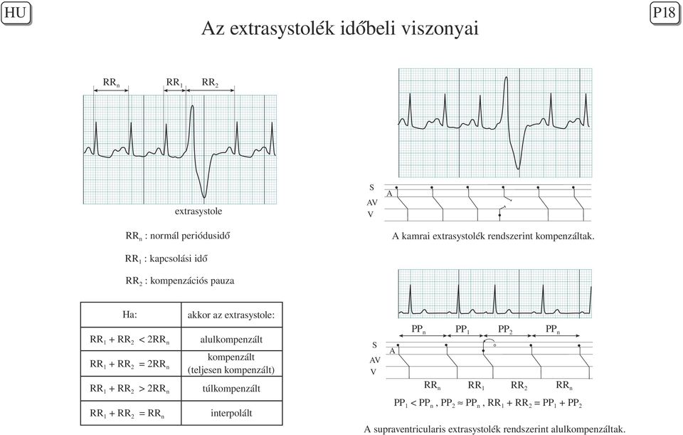 RR1 : kapcsolási idő RR2 : kompenzációs pauza Ha: akkor az extrasystole: RR1 RR2 < 2RRn alulkompenzált RR1 RR2 = 2RRn