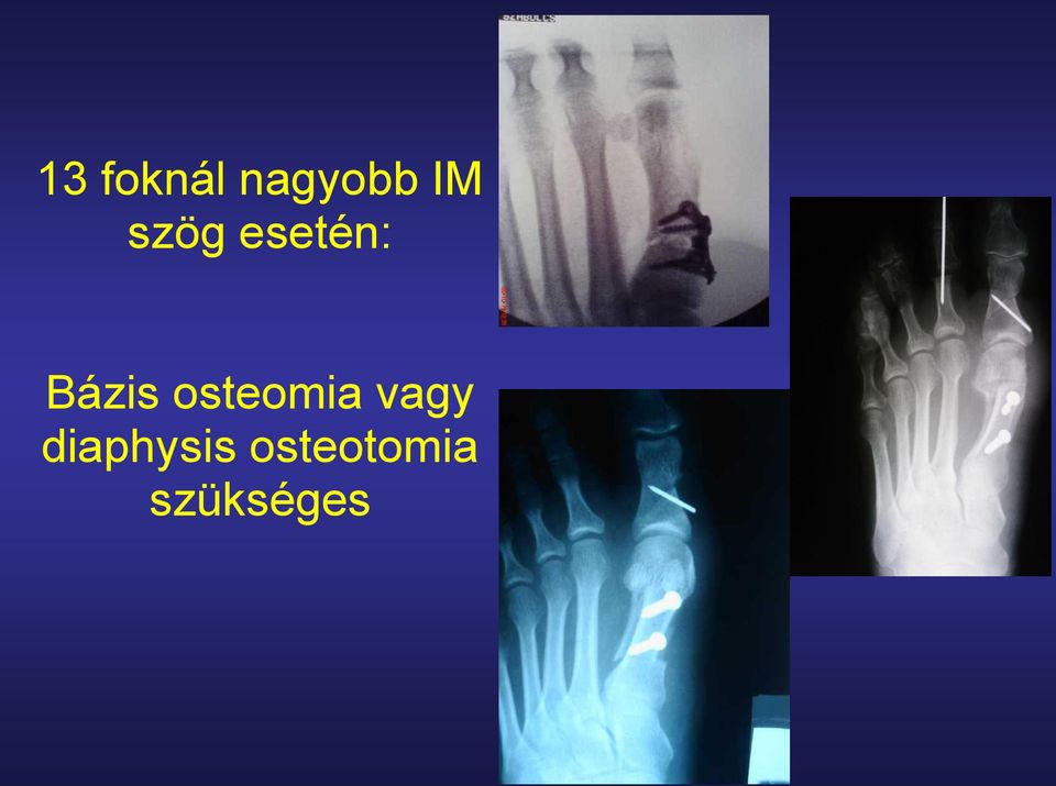 osteomia vagy